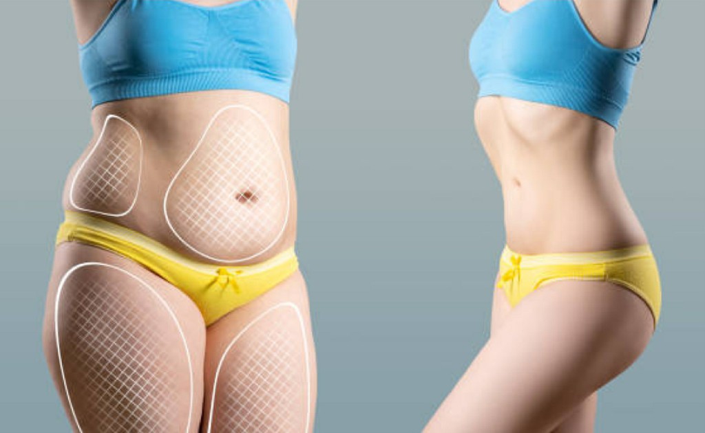 Abdomen Plastic Surgeries Abdomen Plastic Surgeries