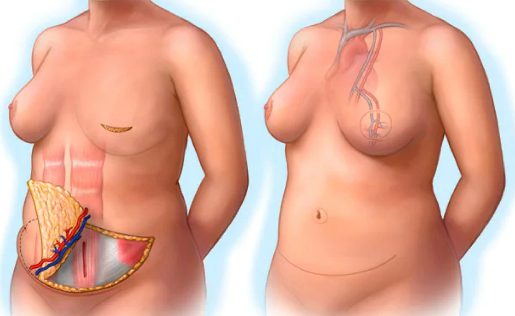 Breast Cancer Surgery Breast Cancer Surgery