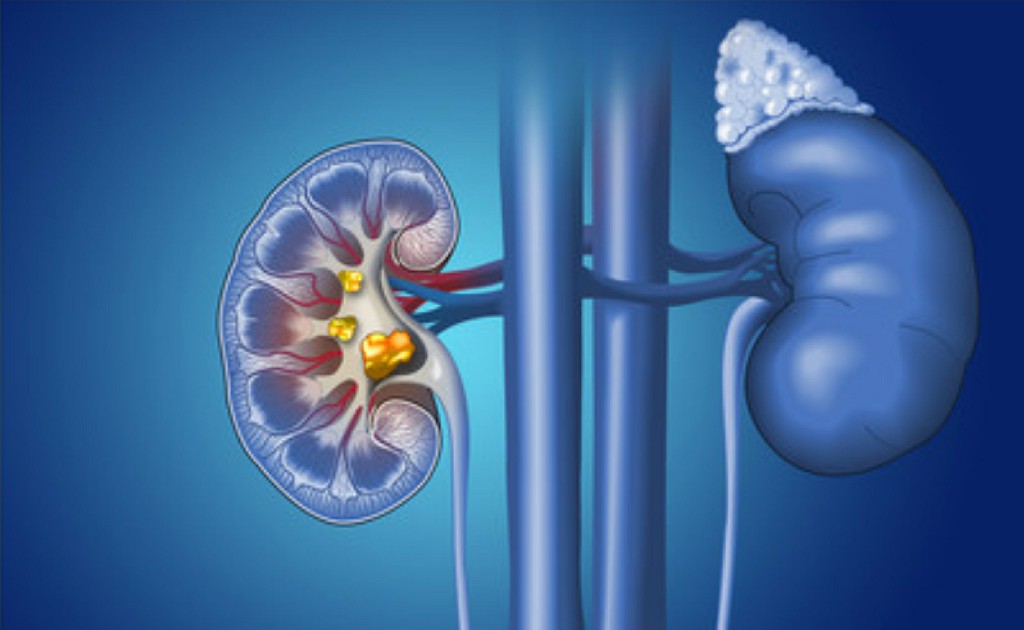 Calculi Urinary Tract Stones Calculi Urinary Tract Stones