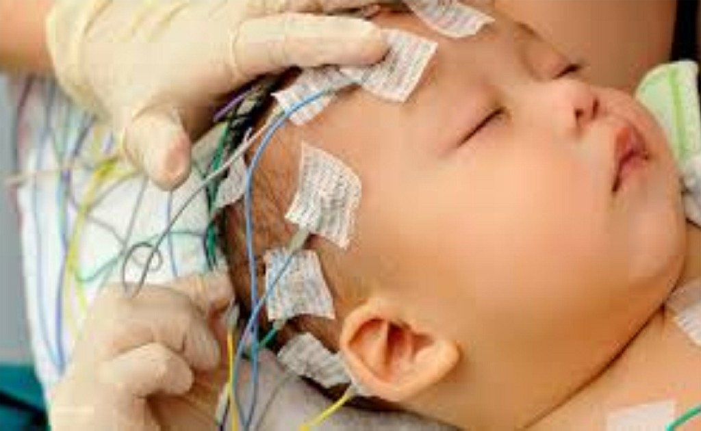 Epilepsy Surgery Epilepsy Surgery