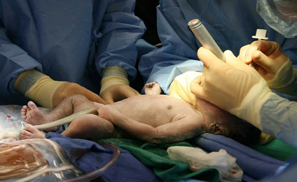 Episiotomy Episiotomy