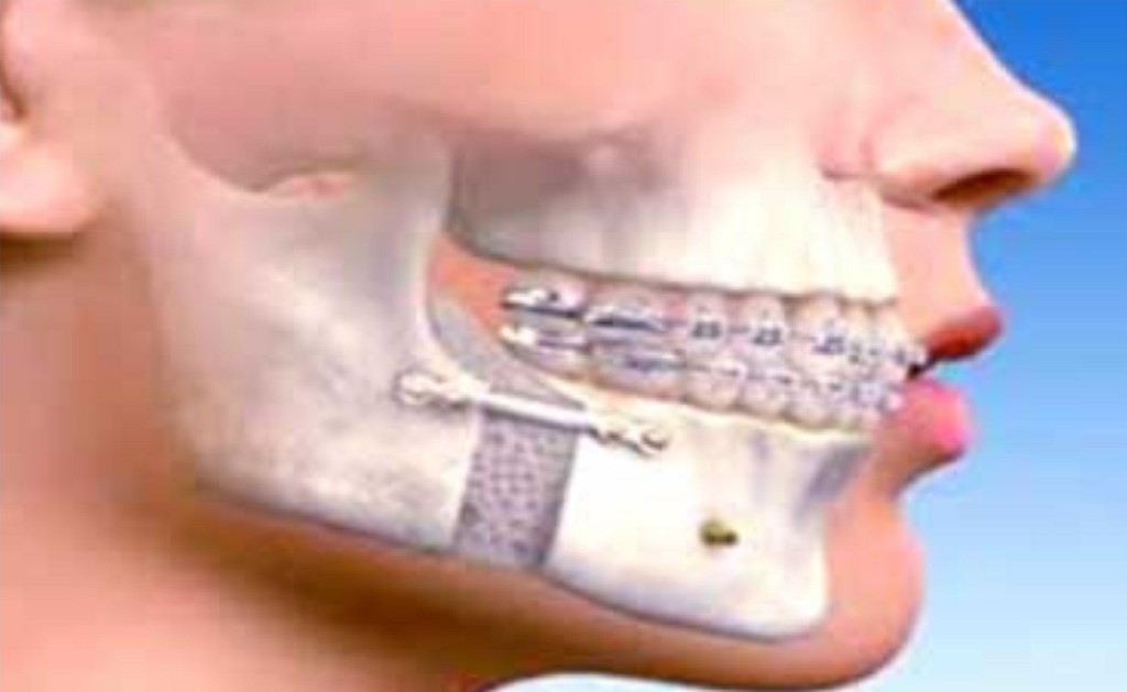 Facio Maxillary Surgery Facio Maxillary Surgery