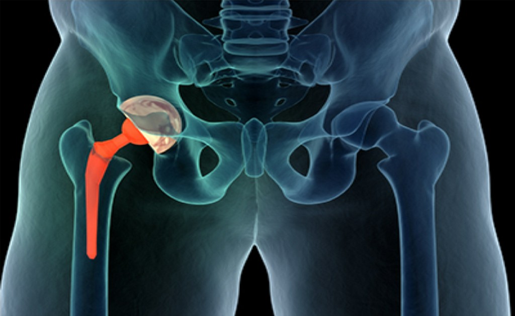 HIP Replacement HIP Replacement