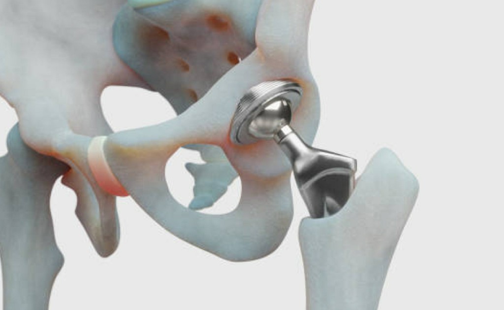 Hip Replacement 1 Hip Replacement
