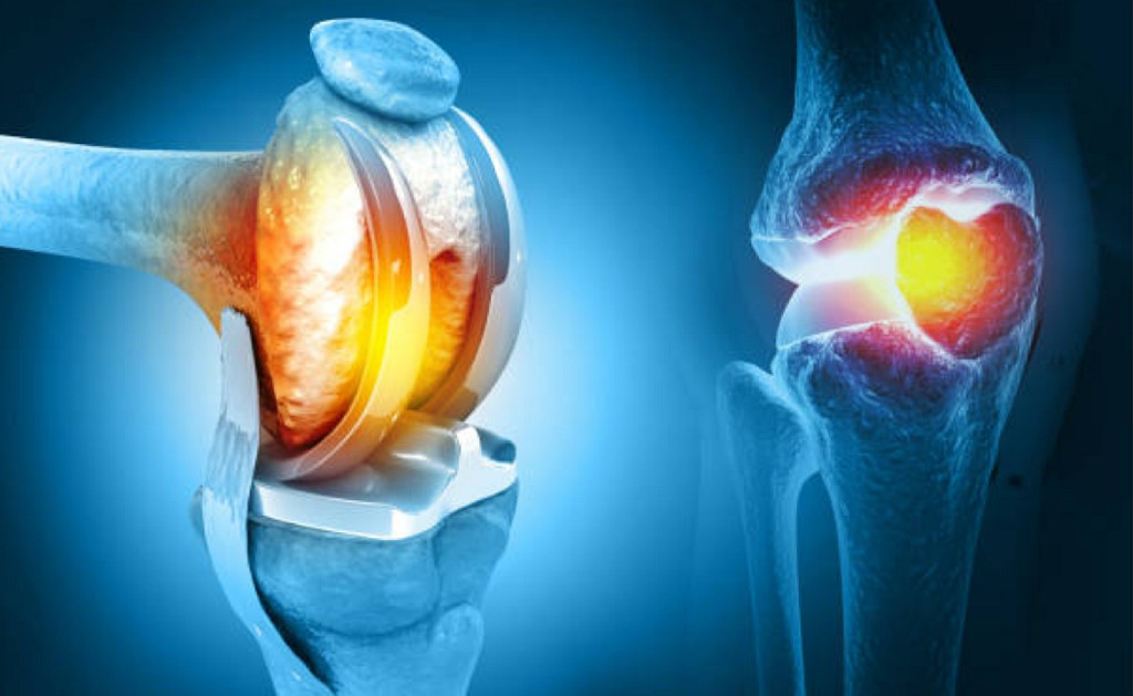 Knee Replacement Knee Replacement