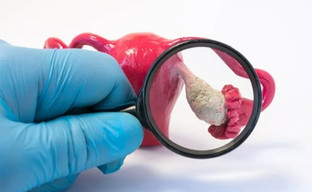 Oophorectomy Oophorectomy