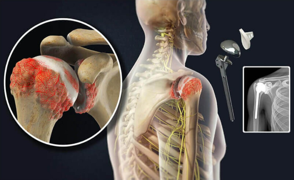 Shoulder Replacement Shoulder Replacement