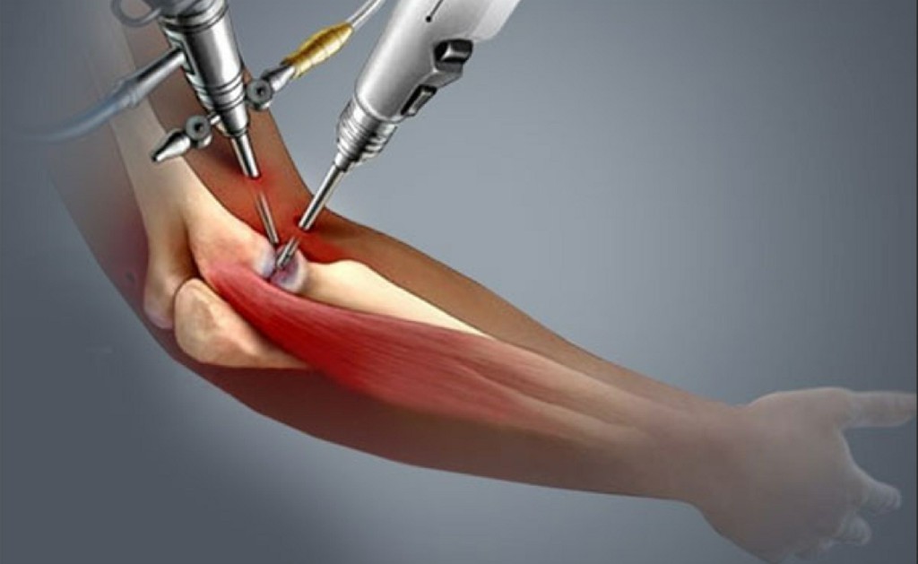 Total Elbow Replacement Total Elbow Replacement