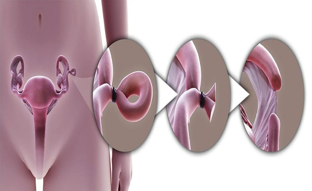 Tubal Ligation Tubal Ligation