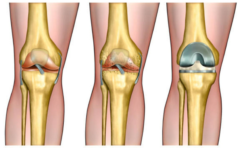 joint replacement surgery joint replacement surgery