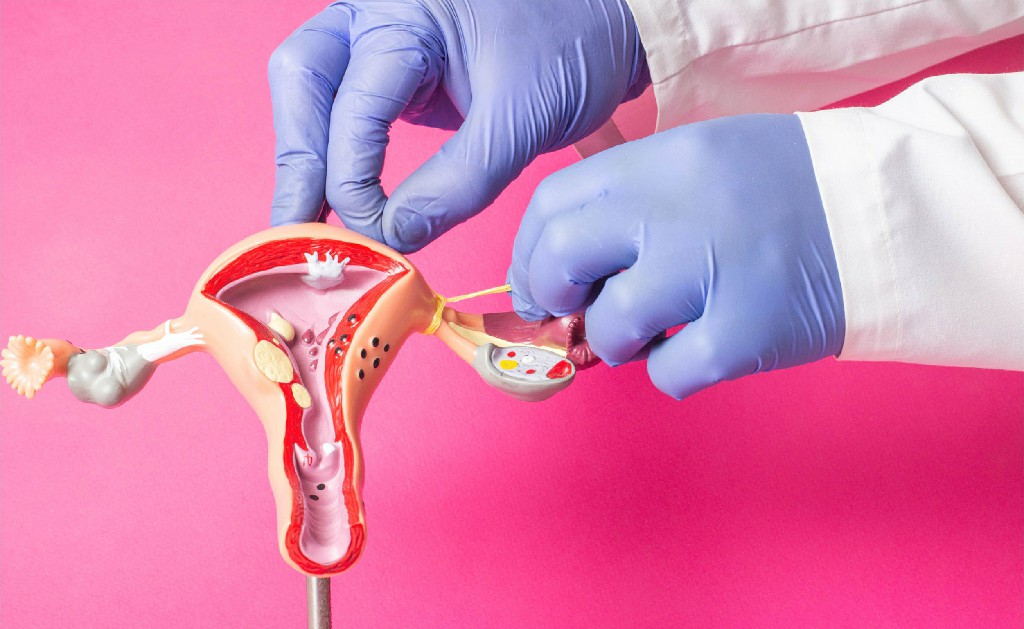 3 Inguinal Hernia