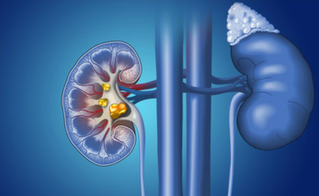 Kidney Stones Inguinal Hernia