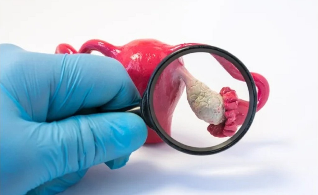 Polycystic Ovarian Disease (PCOD) Incisional Hernia