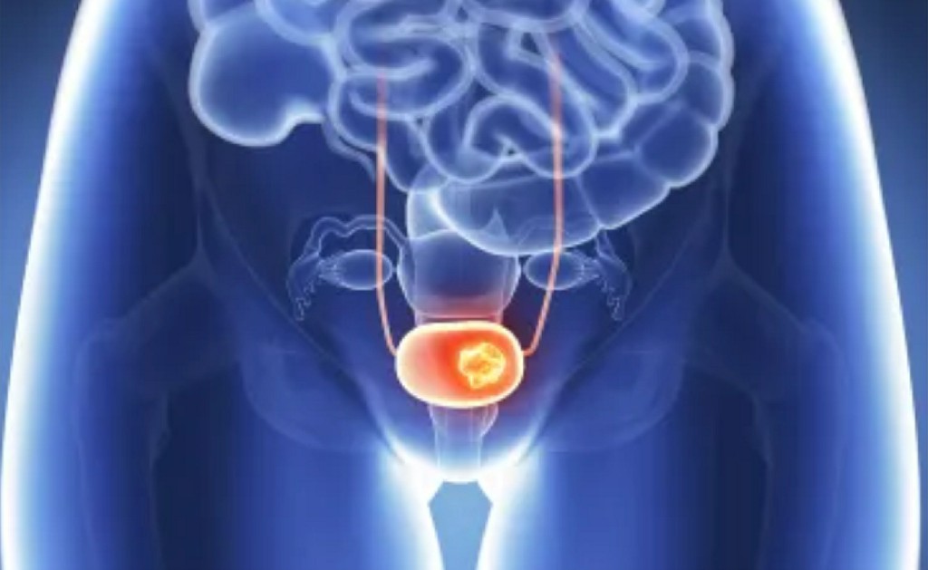 Prostate Enlargement Laparoscopic Surgery N B Hospital Dr, Kasa Somasekhar Ballari