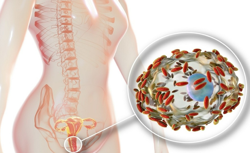 Vaginal Discharge Misconceptions Treatment Incisional Hernia