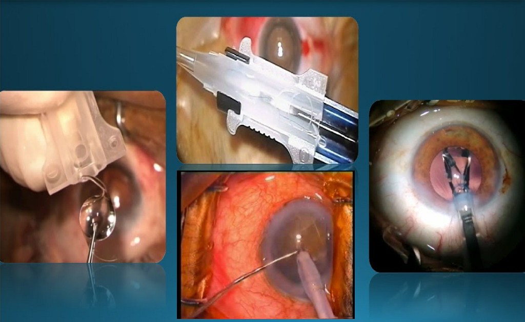 Foldable Iol Implantation Kulkarni Eye Hospital Ballari Foldable Iol Implantation Kulkarni Eye Hospital Ballari