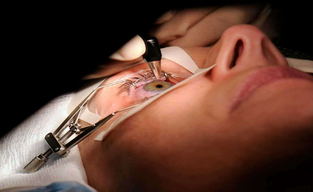 Glaucoma Surgery (trabeculectomy) Kulkarni Eye Hospital Ballari Glaucoma Surgery (trabeculectomy) Kulkarni Eye Hospital Ballari