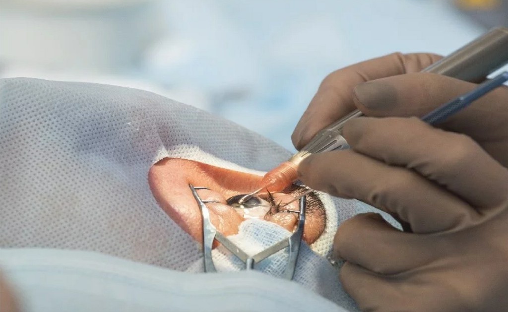 Phacoemulsification (keyhole) Surgery Kulkarni Eye Hospital Ballari Phacoemulsification (keyhole) Surgery Kulkarni Eye Hospital Ballari