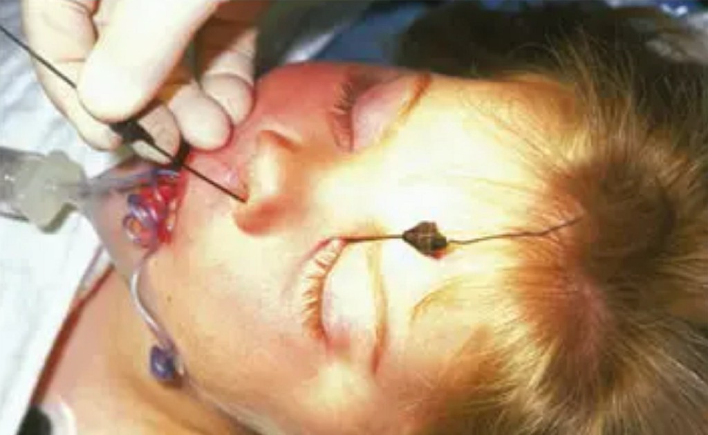 Probing Surgery (Child) Kulkarni Eye Hospital Ballari Probing Surgery (Child) Kulkarni Eye Hospital Ballari
