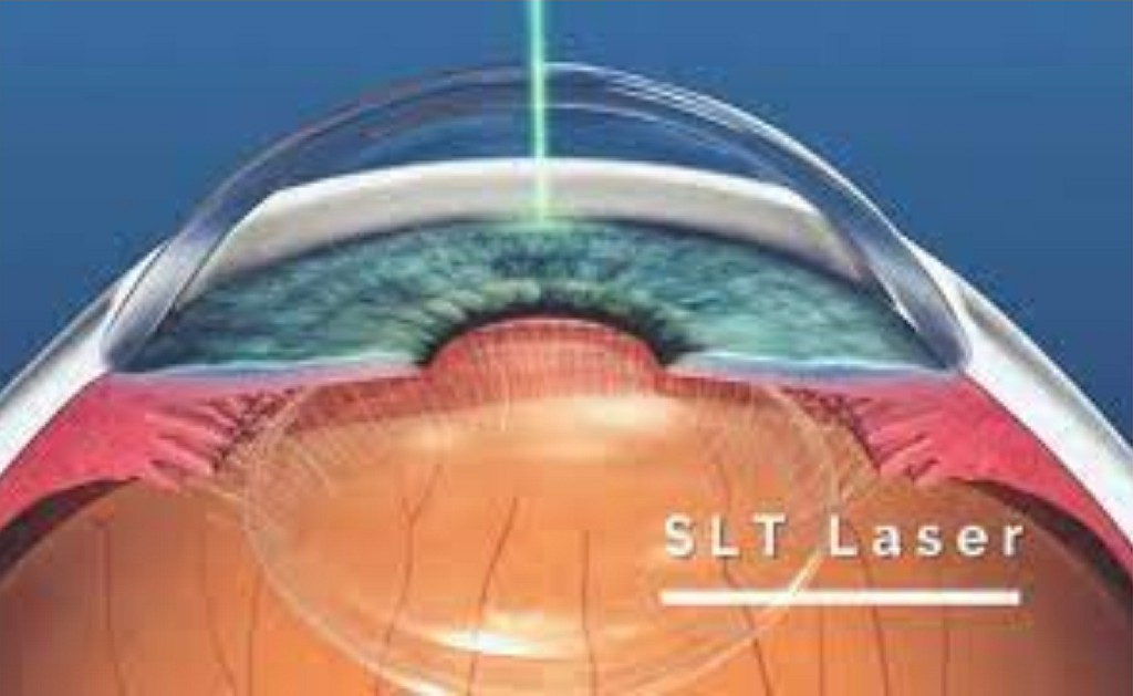 Selective Laser Trabeculoplasty Kulkarni Eye Hospital Ballari Selective Laser Trabeculoplasty Kulkarni Eye Hospital Ballari