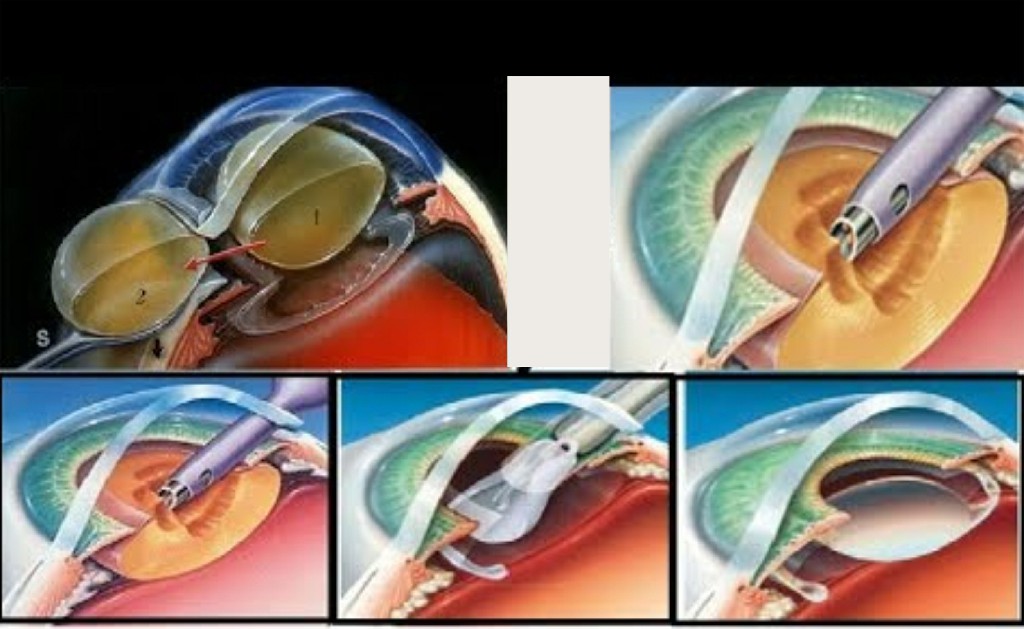 Suture Less Cataract Surgery Kulkarni Eye Hospital Ballari Suture Less Cataract Surgery Kulkarni Eye Hospital Ballari