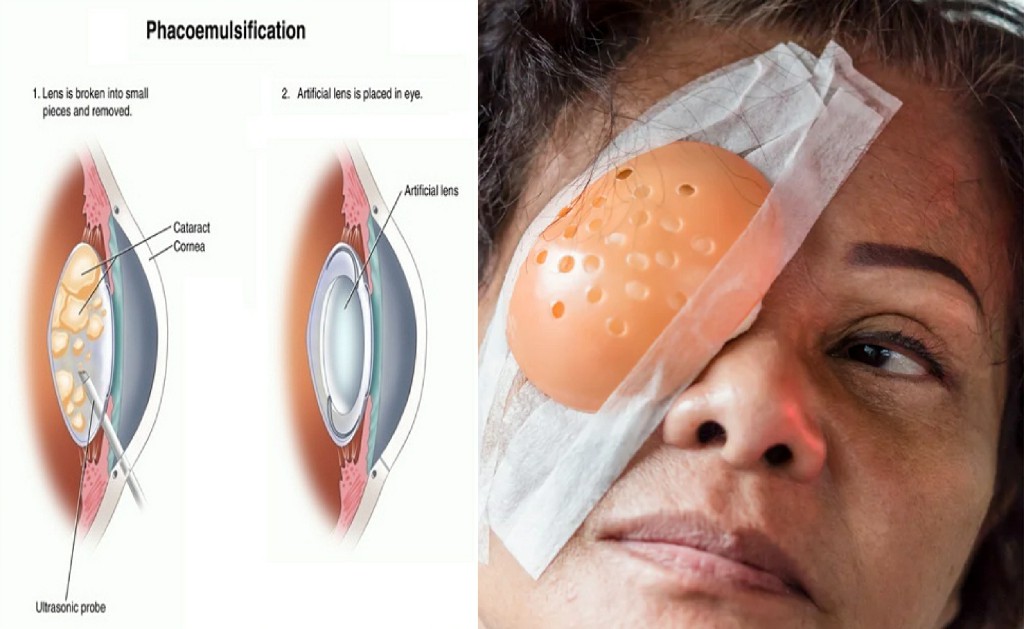 Topical Mics Phacoemulsification Kulkarni Eye Hospital BallariTopical Mics Phacoemulsification Kulkarni Eye Hospital Ballari Topical Mics Phacoemulsification Kulkarni Eye Hospital Ballari