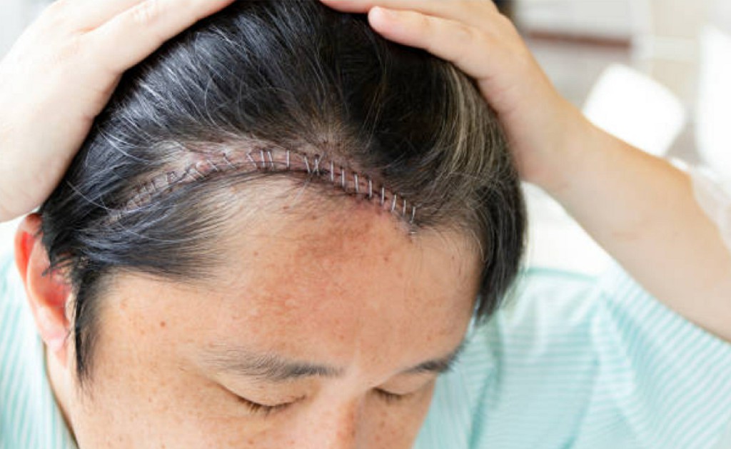 Craniotomy Surgery Craniotomy Surgery