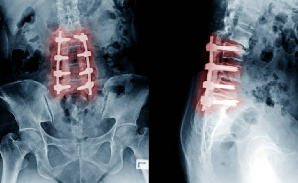 Decompression Surgery Decompression Surgery
