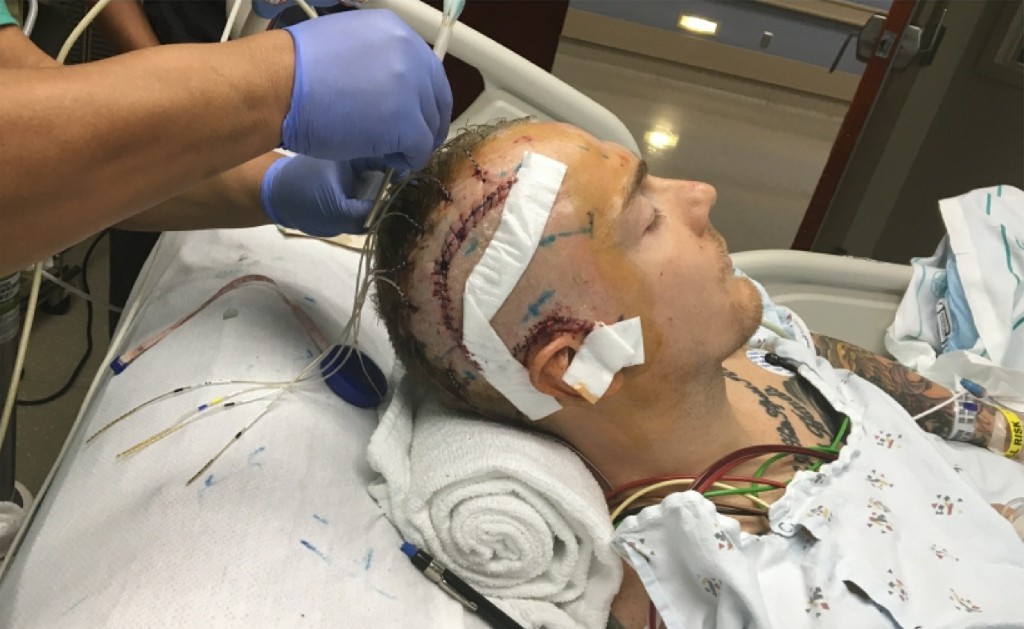 Epilepsy Surgery Epilepsy Surgery