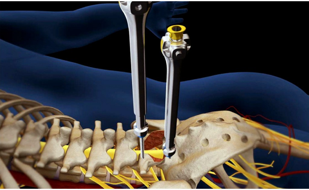 Herniated Disc Surgery Herniated Disc Surgery