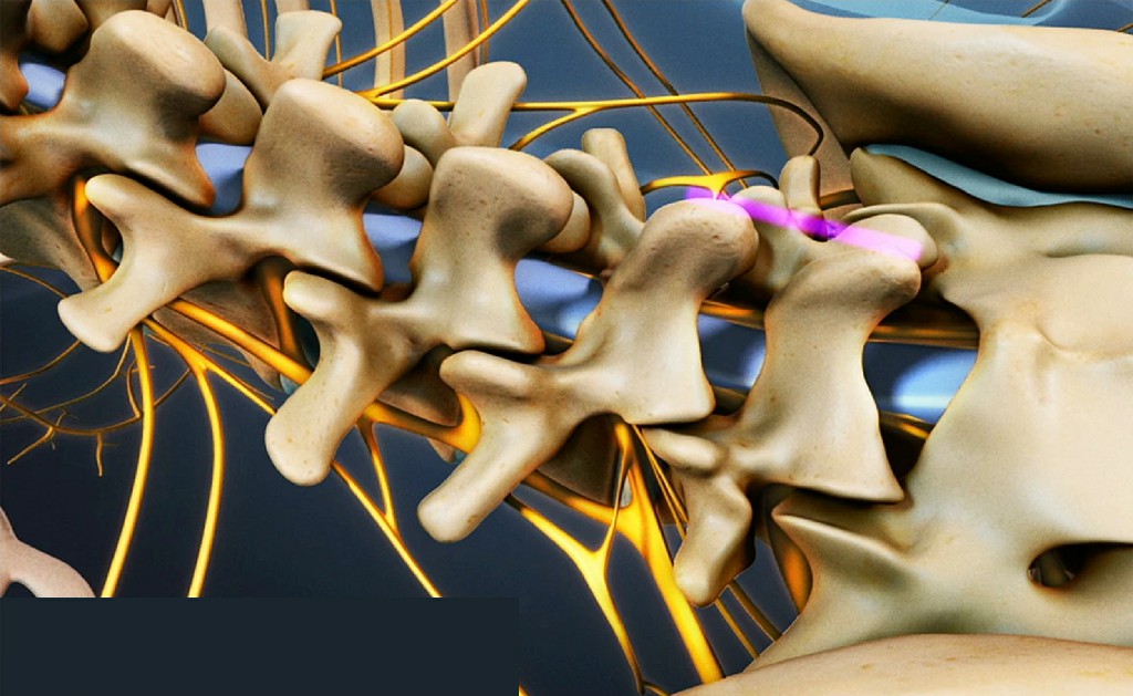 Lumbar Discectomy Surgery Lumbar Discectomy Surgery