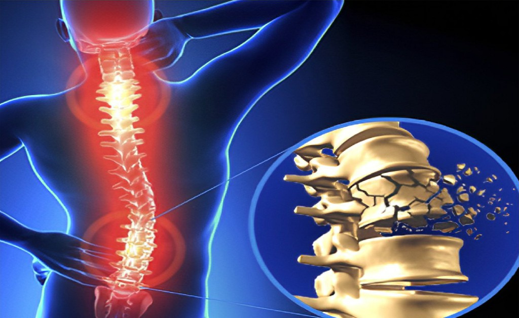 Spinal Cord Injuries Treatment Spinal Cord Injuries Treatment