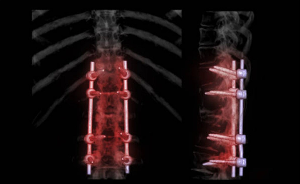 Spinal Fusion Surgery Spinal Fusion Surgery