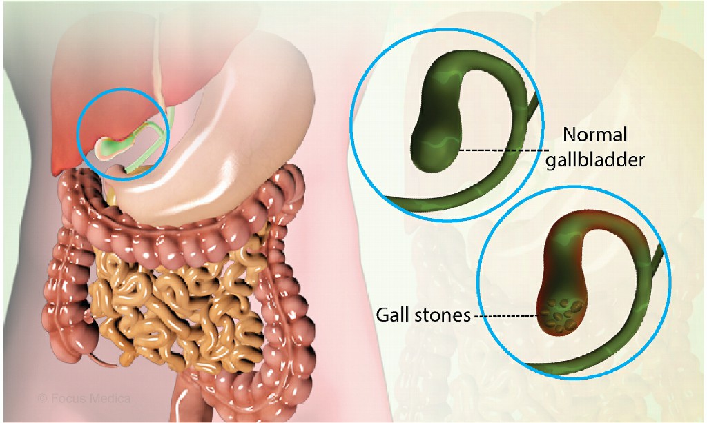 Cholecystitis Cholecystitis