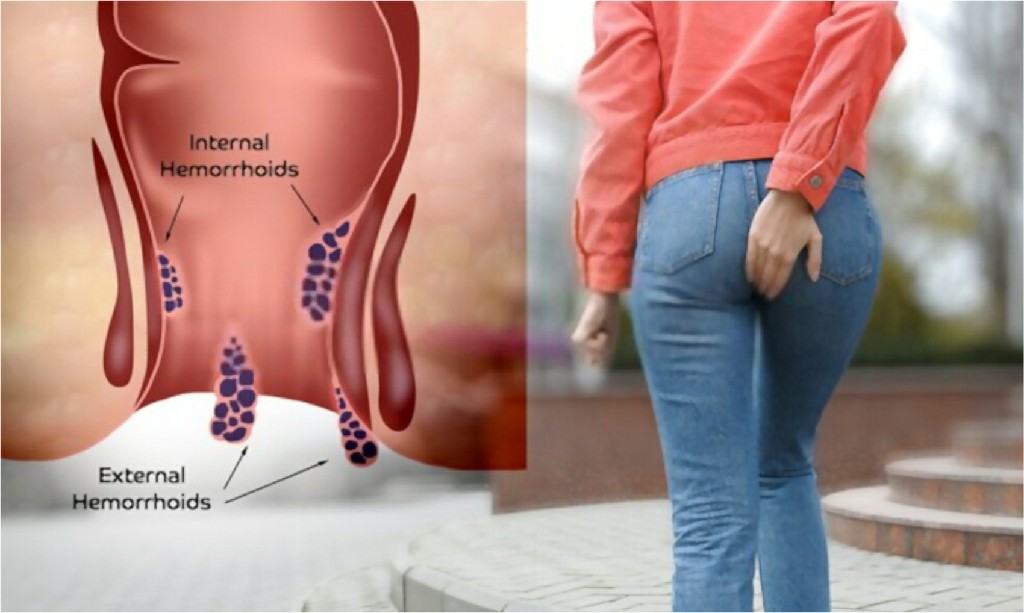 Fistula Fistula, N B Hospital Dr, Kasa Somasekhar Ballari