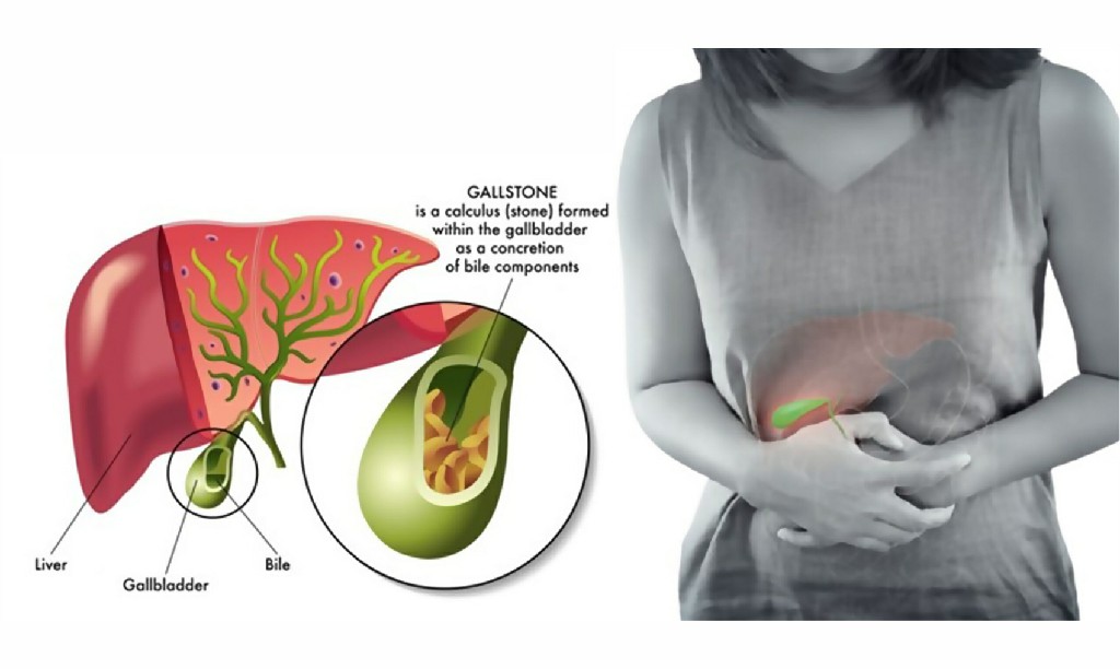 Gallstones Gallstones