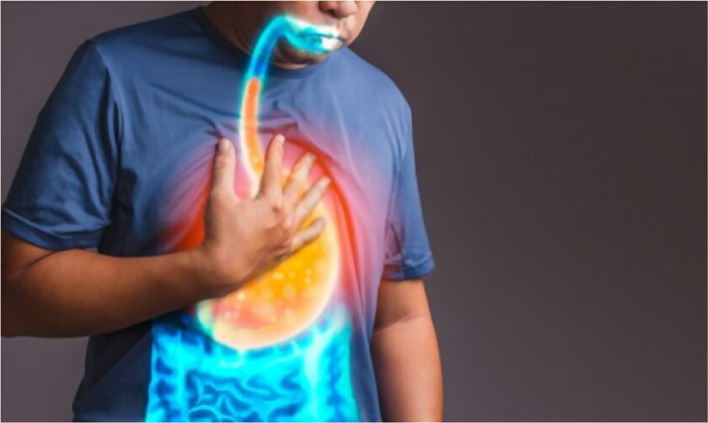Gerd Reflux Disease Gerd Reflux Disease, N B Hospital Dr, Kasa Somasekhar Ballari
