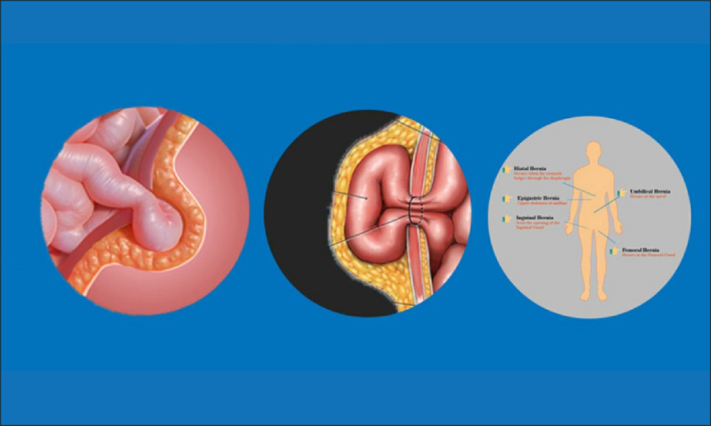 Hernia Open Surgery Hernia Open Surgery N B Hospital Dr, Kasa Somasekhar Ballari