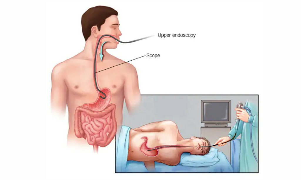 Hiatus Hernia Hiatus Hernia
