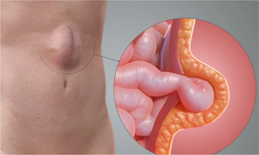 Incisional Hernia Incisional Hernia