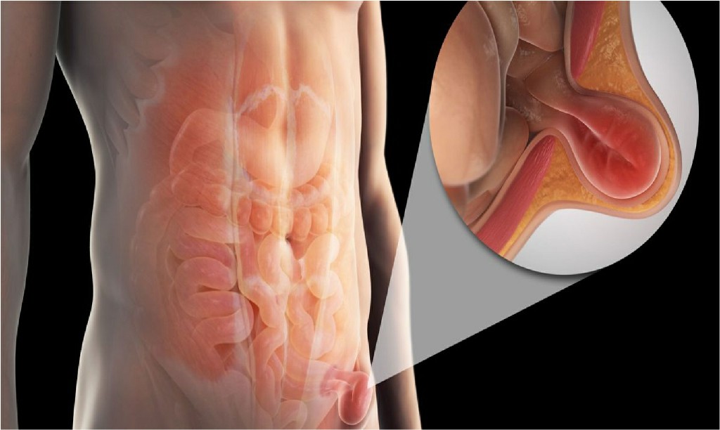 Inguinal Hernia Inguinal Hernia