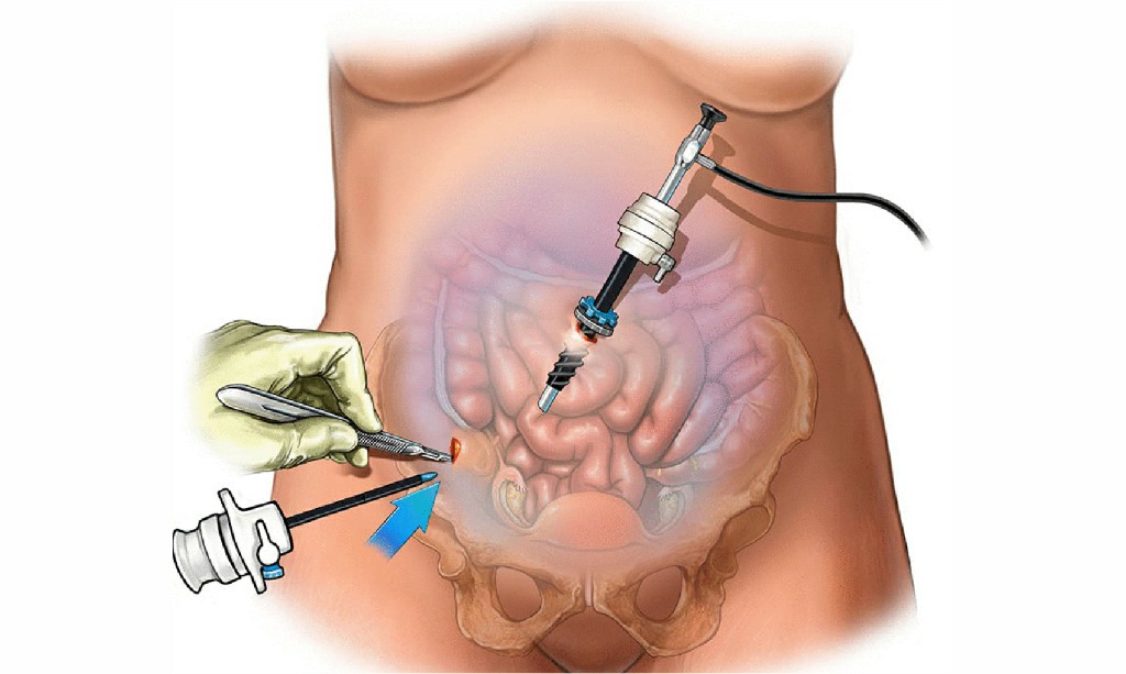 Laparoscopic Surgery Laparoscopic Surgery N B Hospital Dr, Kasa Somasekhar Ballari