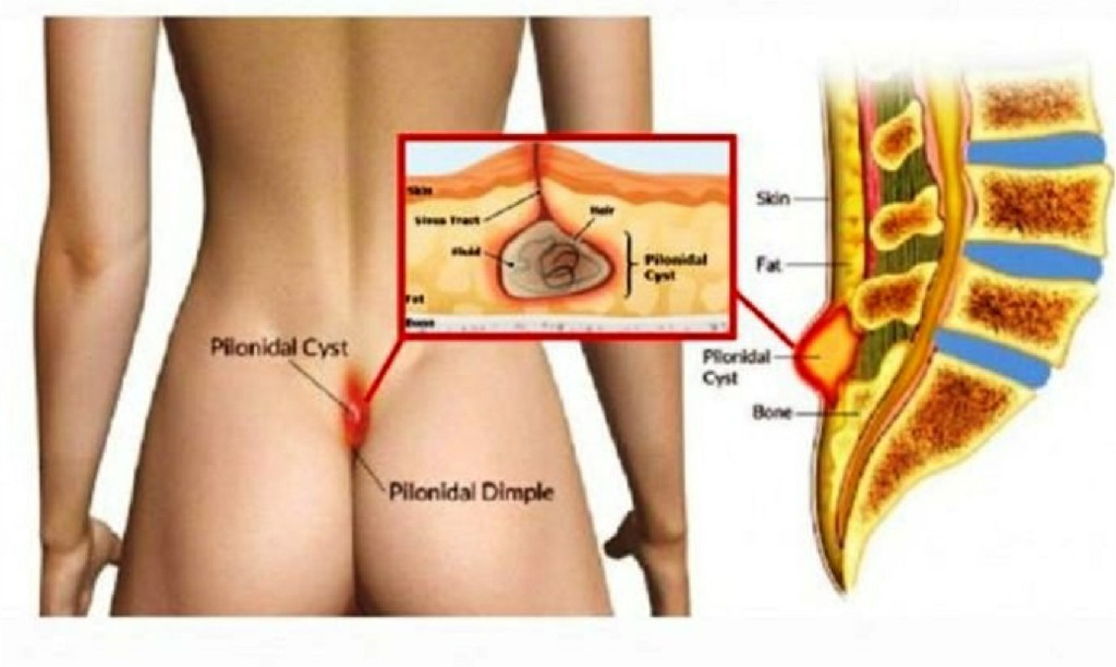 Pilonidal Sinus Pilonidal Sinus N B Hospital Dr, Kasa Somasekhar Ballari
