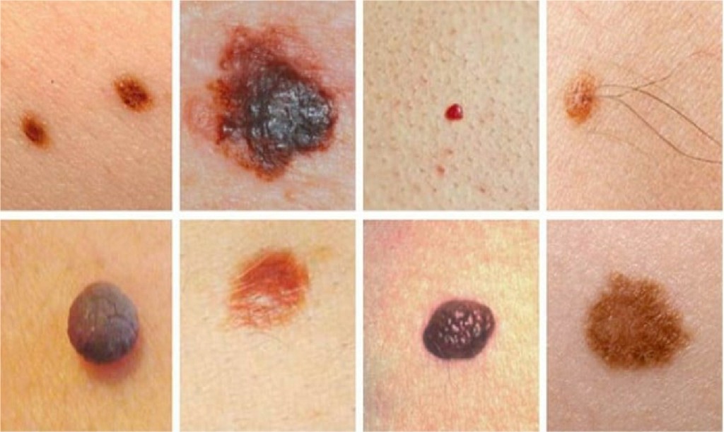Skin Tumours Skin Tumours N B Hospital Dr, Kasa Somasekhar Ballari