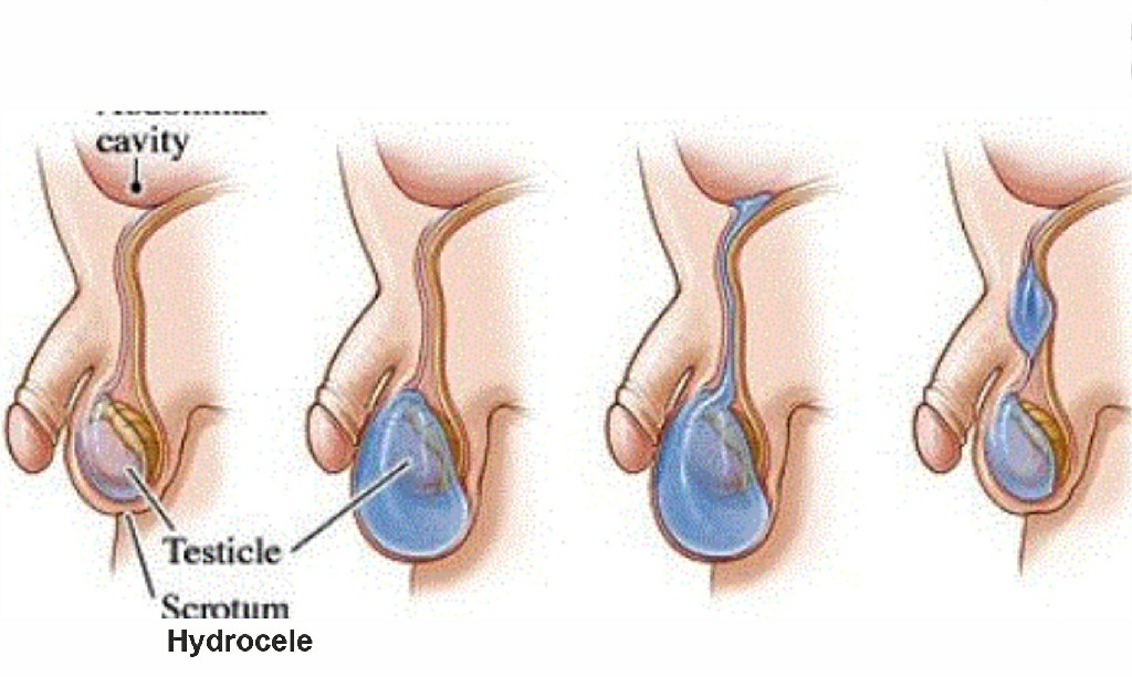 Testicular Disease Hydrocele Testicular Disease Hydrocele N B Hospital Dr, Kasa Somasekhar Ballari