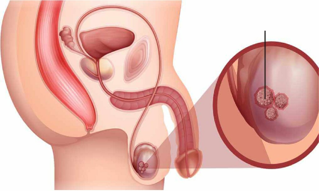 Testicular Disease Testicular Disease N B Hospital Dr, Kasa Somasekhar Ballari