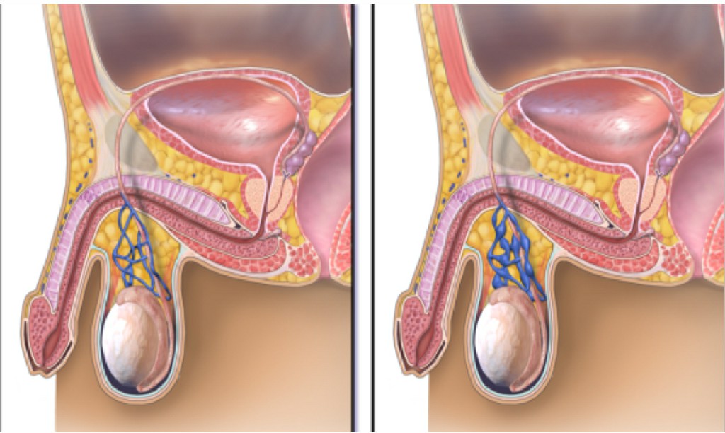 Varicocele Hydrocele Varicocele Hydrocele N B Hospital Dr, Kasa Somasekhar Ballari