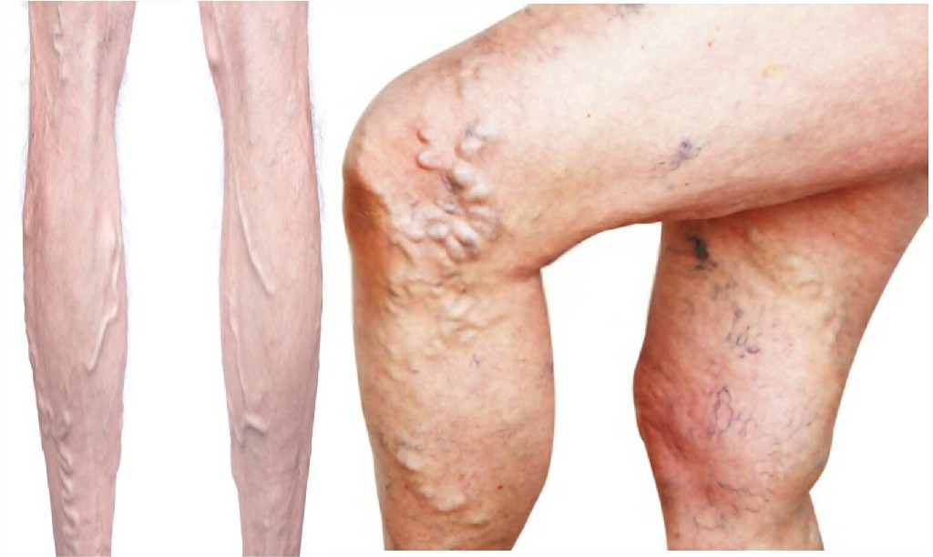 Varicose Veins Varicose Veins N B Hospital Dr, Kasa Somasekhar Ballari