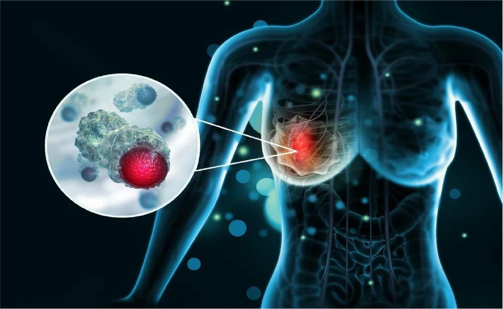Brest Cancer Cancer Laparoscopic Surgeon
