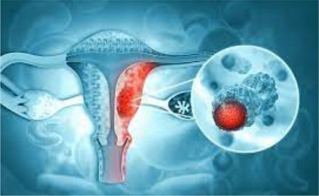 Gynecological Cancer Head and Neck Reconstruction Surgery